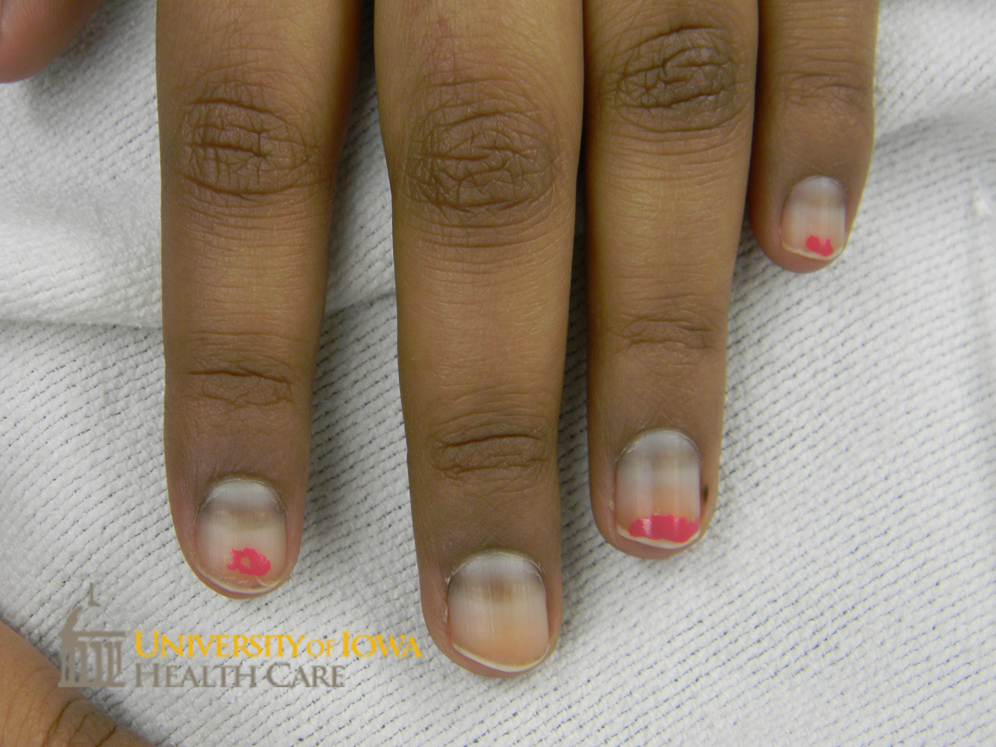 A transverse brown band on the proximal fingernails. (click images for higher resolution).